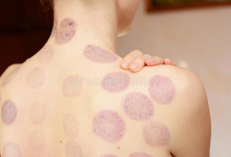 Cupping Marks vs. Bruises: What the Evidence Actually Shows