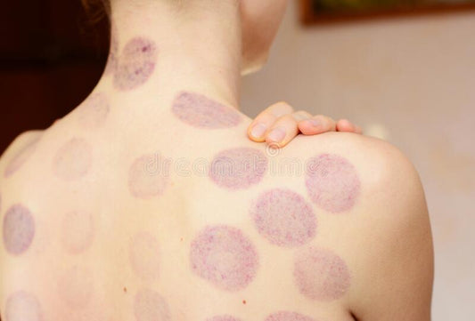 Cupping Marks vs. Bruises: What the Evidence Actually Shows