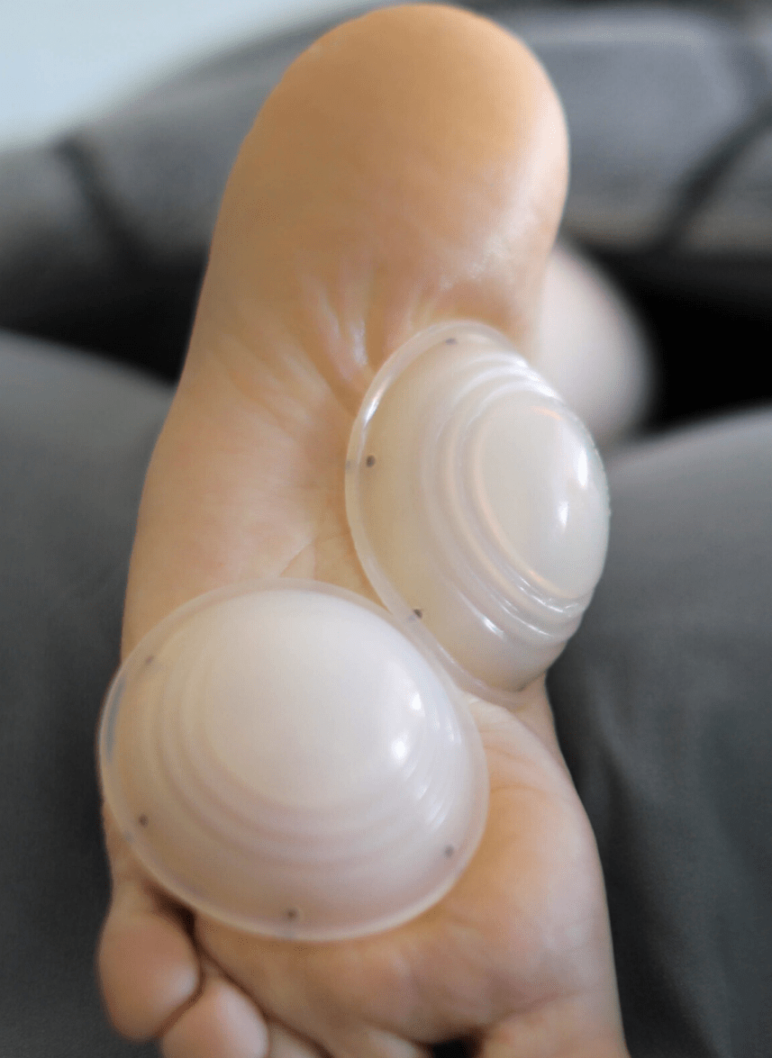 Cupping Therapy for Plantar Fasciitis
